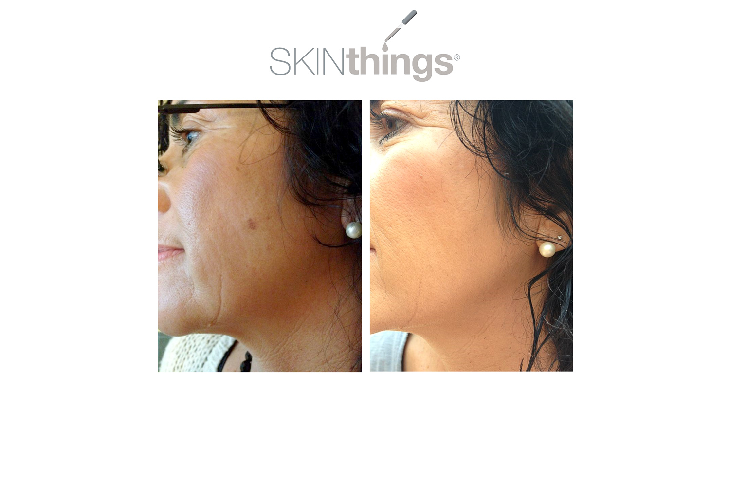 Vorher Nachher Pigmentfleck Freezer