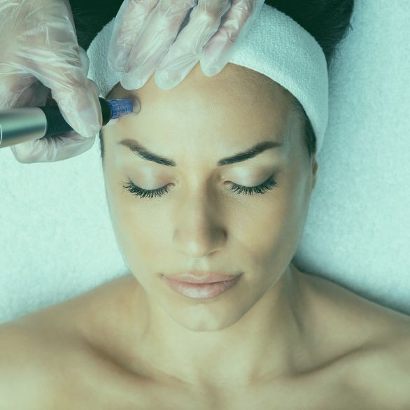 Microneedling in Düsseldorf Carlsplatz